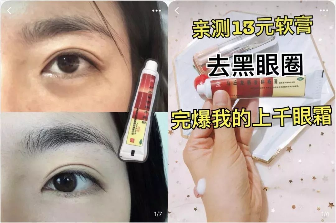 马应龙痔疮膏救了好多人,马应龙痔疮膏黑眼圈亲身体验