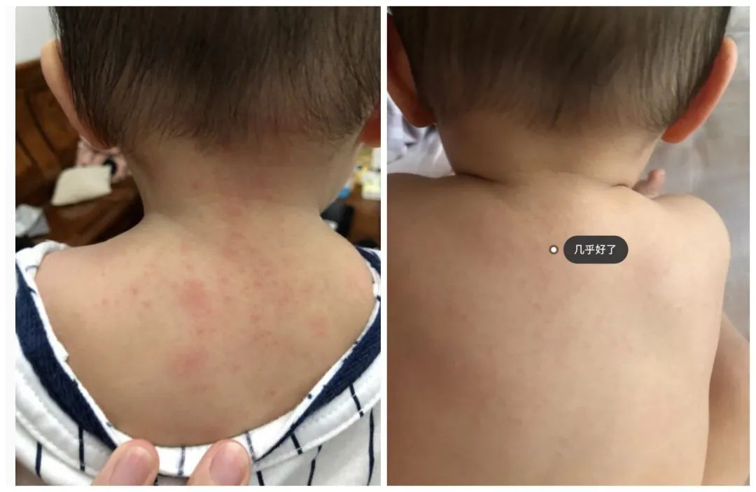 老是感觉身上痒痒的是螨虫吗,总觉得身上痒有虫子爬怎么回事