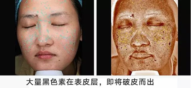 让脸上斑去掉,让脸上的皮肤变白