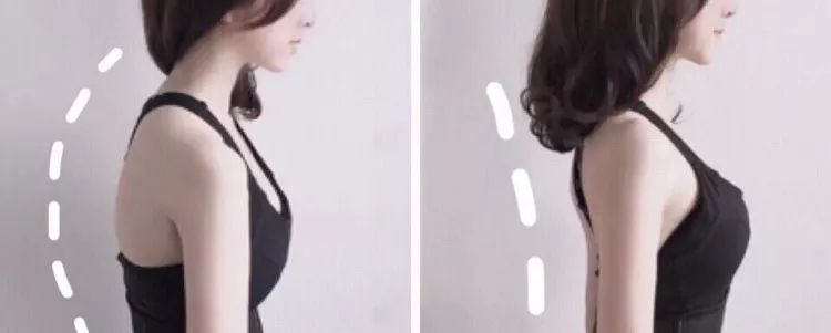 有什么方法可以改善含胸驼背,含胸驼背改善的方法