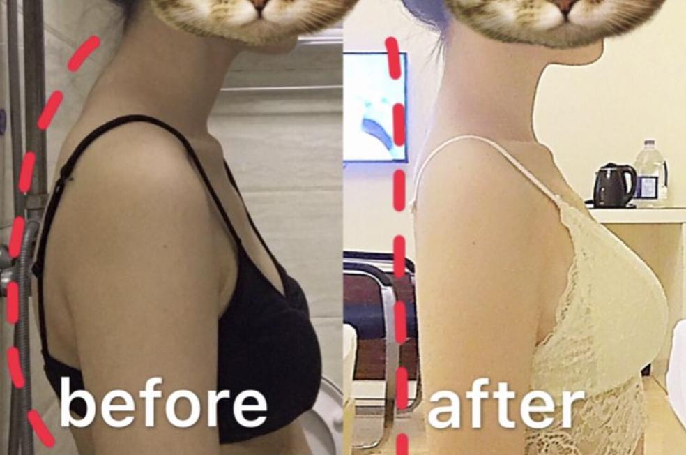 有什么方法可以改善含胸驼背,含胸驼背改善的方法