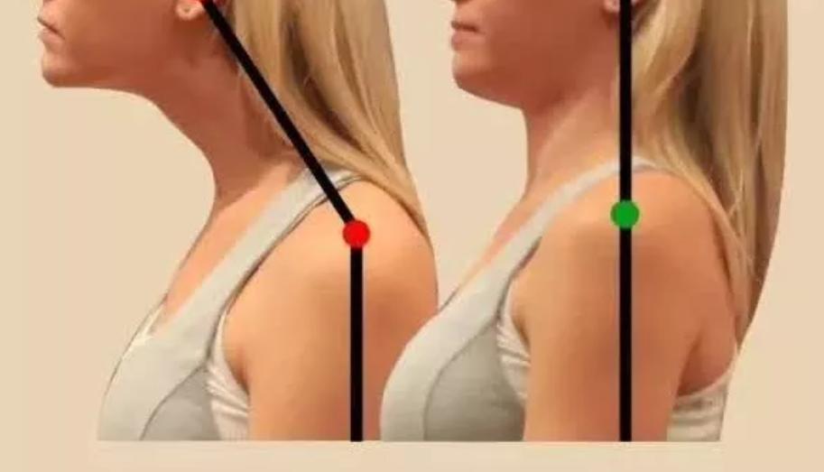 有什么方法可以改善含胸驼背,含胸驼背改善的方法