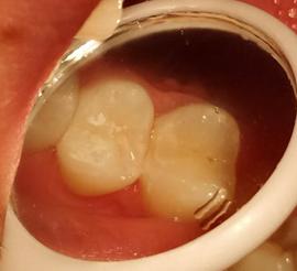 邻面龋可以变成静止龋吗,门牙邻面龋早期怎么处理