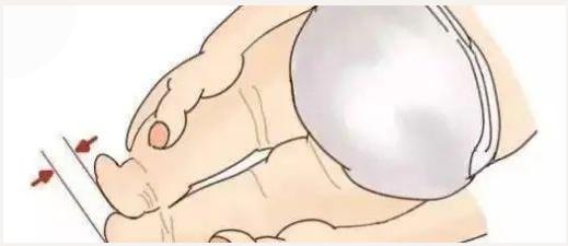 皮纹不对称怎么矫正,宝宝体检皮纹不对称是什么意思