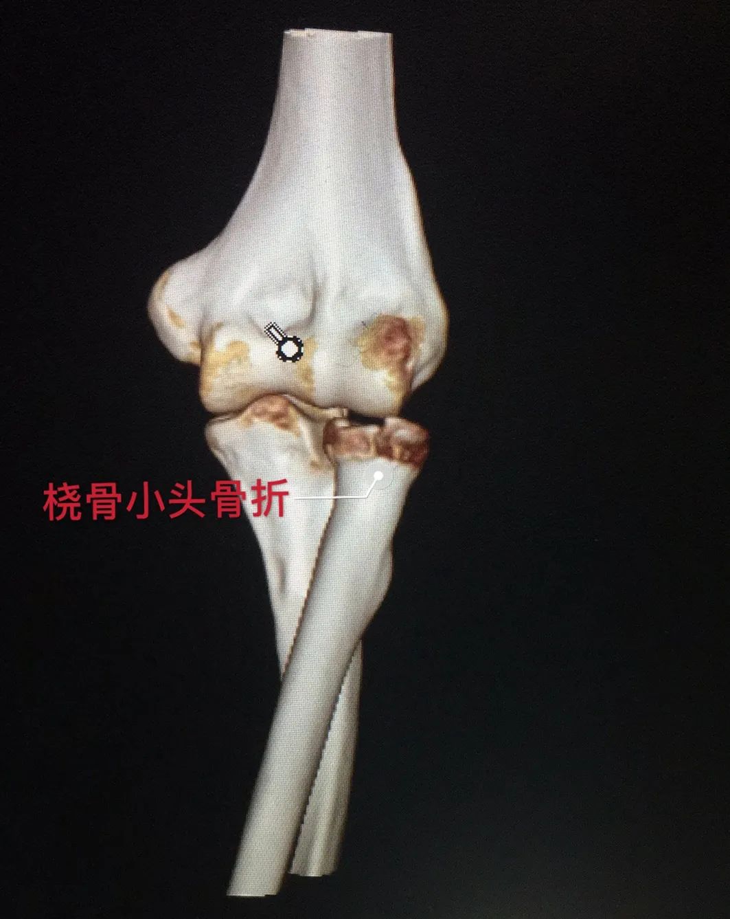 骨折受伤去医院正骨真实最新视频,西安中医正骨复位骨折