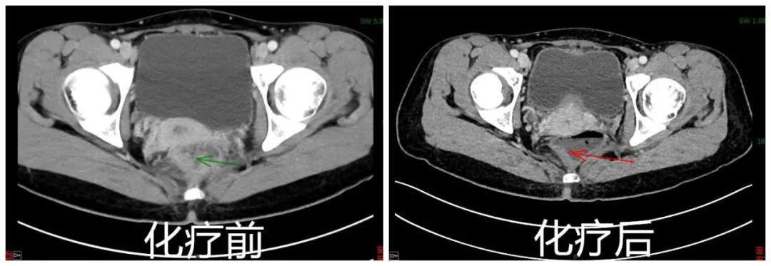 直肠癌扩散还有必要做手术么,直肠癌已经不能动手术了能活多久