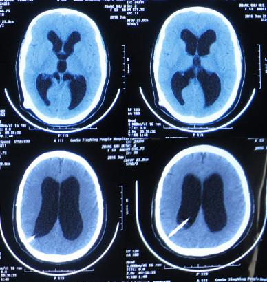 脑积水腹腔分流术后头晕头痛,脑积水分流术后发烧会有什么后果