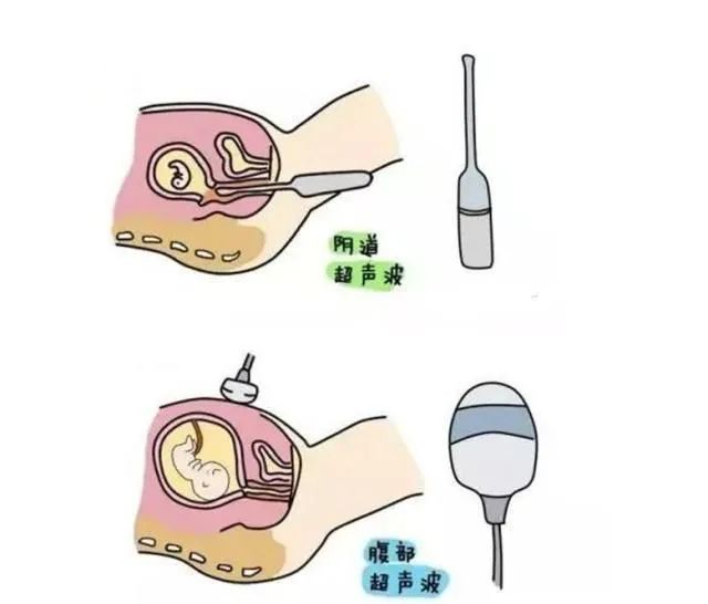 阴超和腹超有多少误差,阴超和腹超价格一样吗