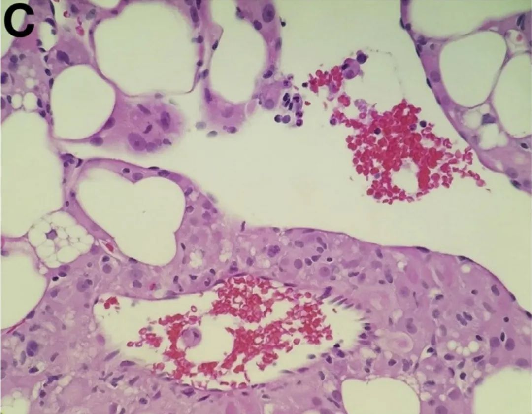 肝脏方面的病例,肝脏罕见病