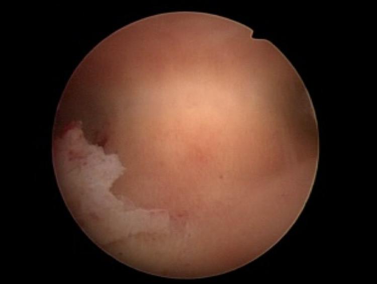 怀孕时宫腔粘连怎么办,宫腔粘连怀孕出血流产