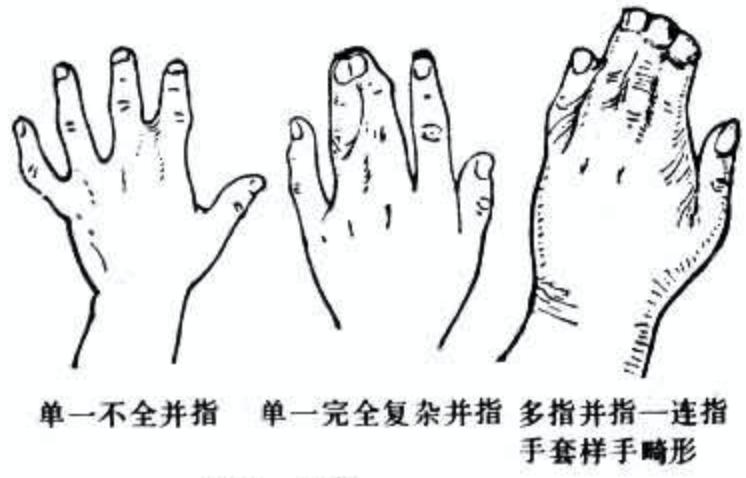 小孩长了6根手指怎么办,婴儿长出多根手指