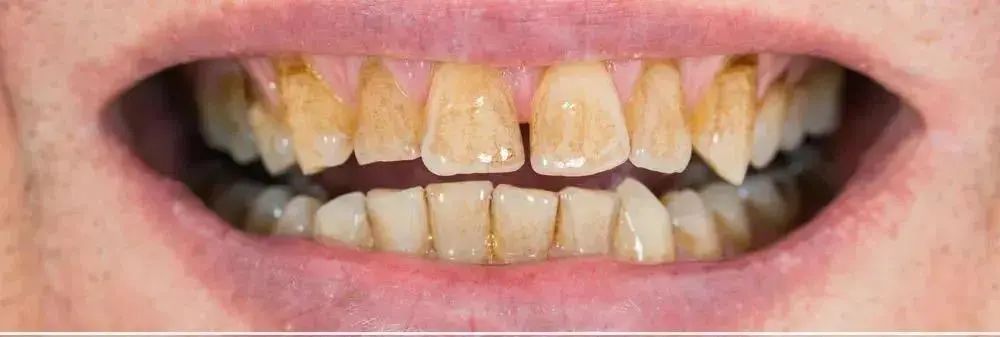 拿什么拯救你我的烂牙,拿什么拯救你的黄牙