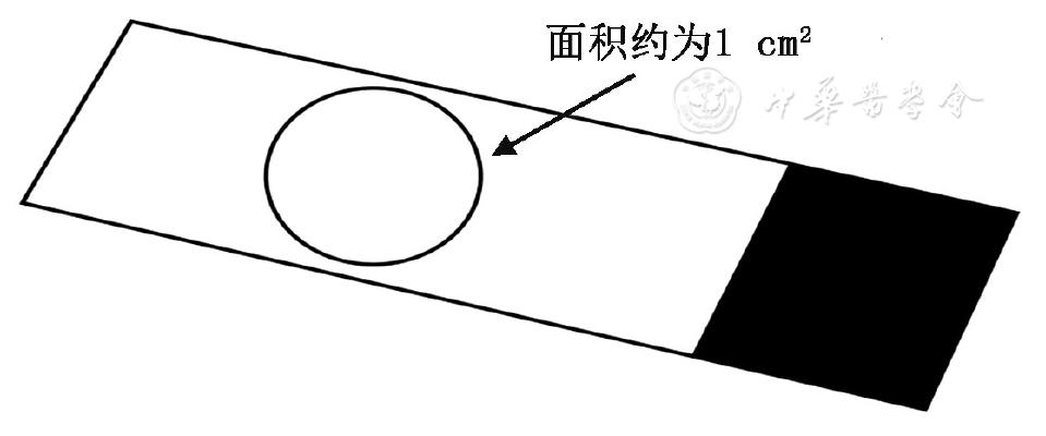 支气管肺泡灌洗术评分标准,肺泡灌洗液涂片检查准确率