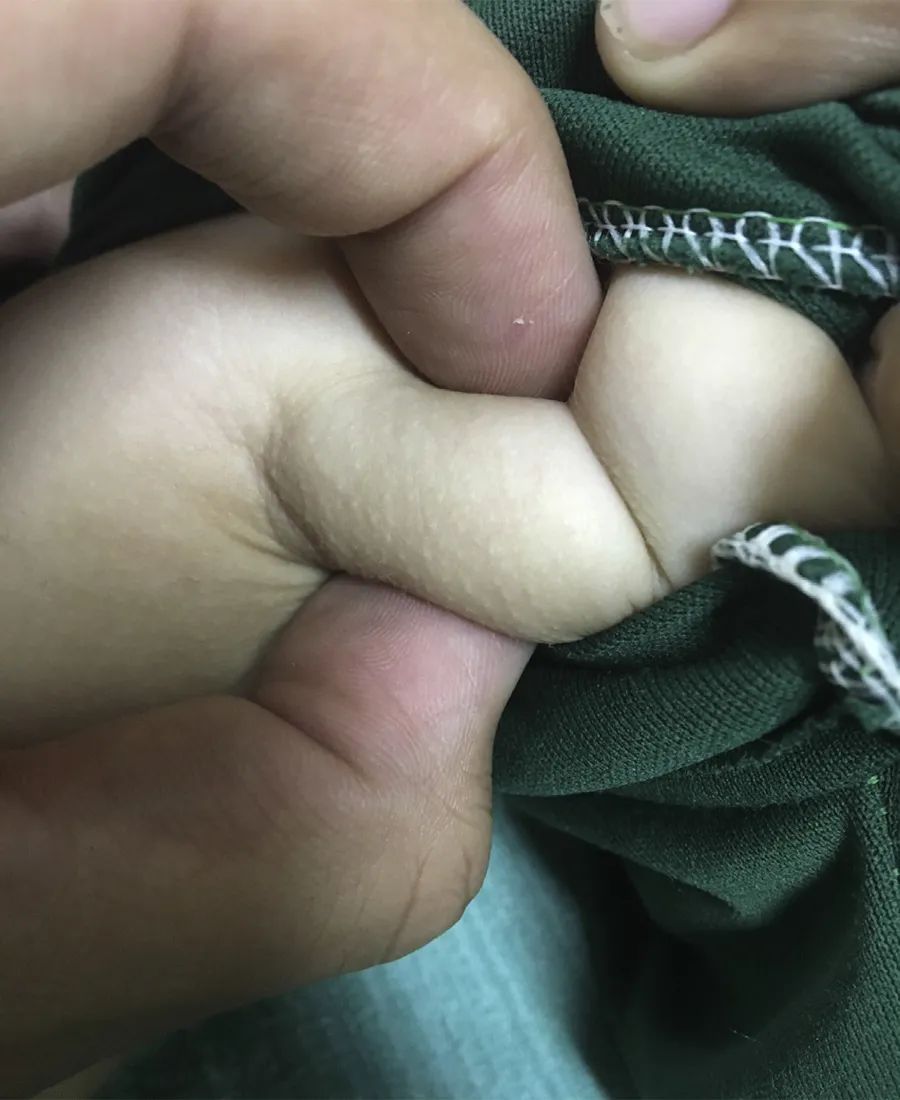 接种卡介苗后疤痕的中间有根粉刺,打了卡介苗腋下有疙瘩