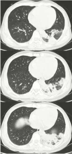 成人肺炎支原体肺炎诊治专家共识,2023肺炎支原体感染中药诊治指南