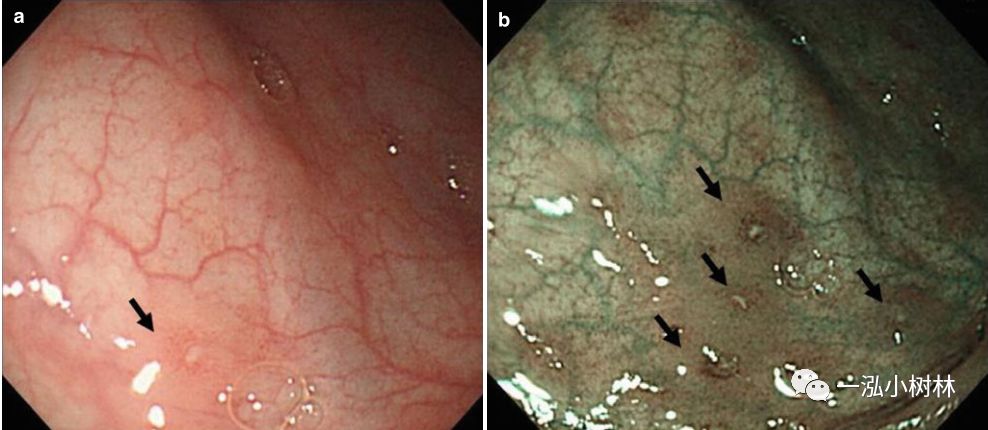 炎症性肠病内镜下表现,炎症性肠病早期筛查结果