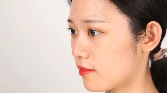 痘痘挤出的白米粒是什么,痘痘挤出来的白色乳浆是什么