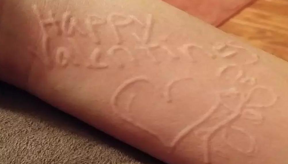 荨麻疹痒得要死,孩子荨麻疹痒死了怎么办