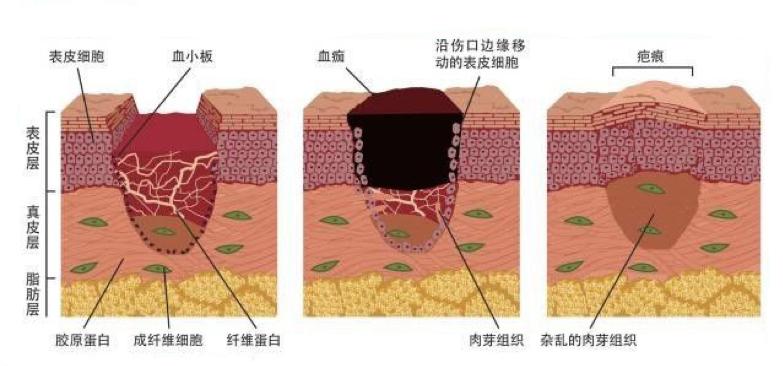 炎症的自述：发生、机理和结局