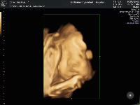 产检B超做二维、三维还是四维？