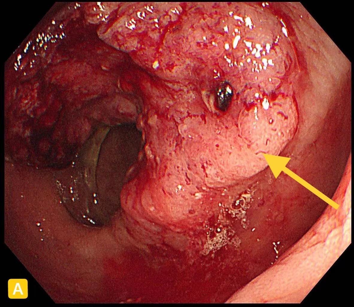 直肠癌术前放疗肛口溃烂,直肠癌科普文章模板