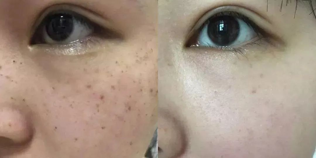 花了3万做激光，才彻底懂了：医生为什么劝你别去斑