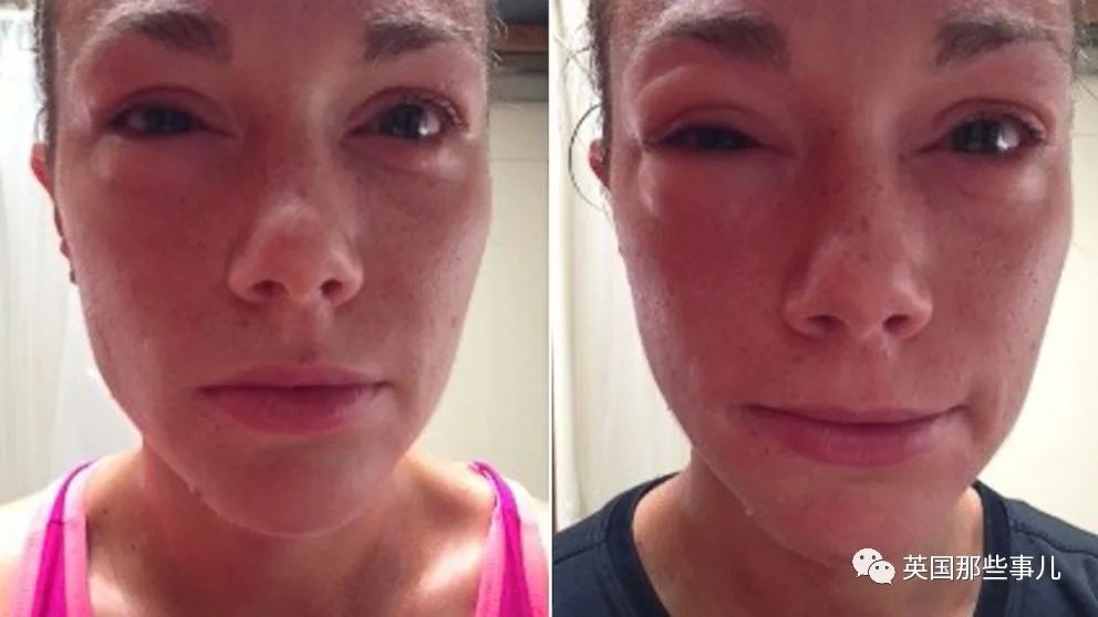 第一次过敏身上起麻疹怎么回事,运动会引起荨麻疹反反复复出现吗