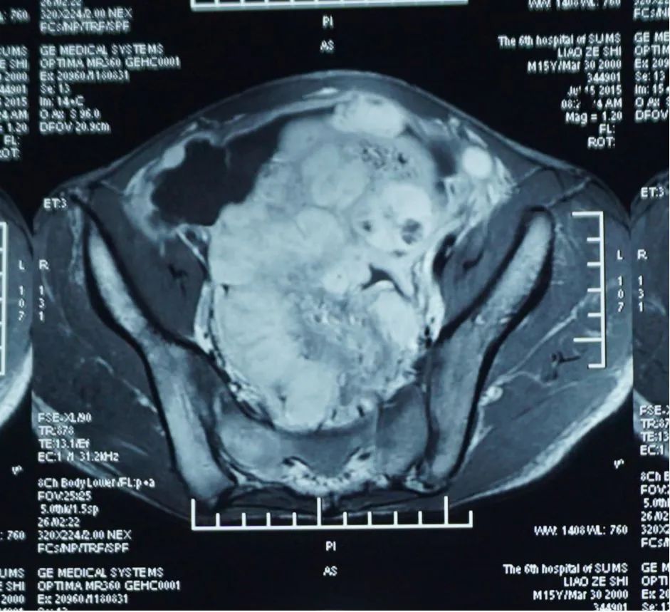 炎性肌纤维母细胞瘤最佳治疗方案,炎性肌纤维母细胞瘤成功案例