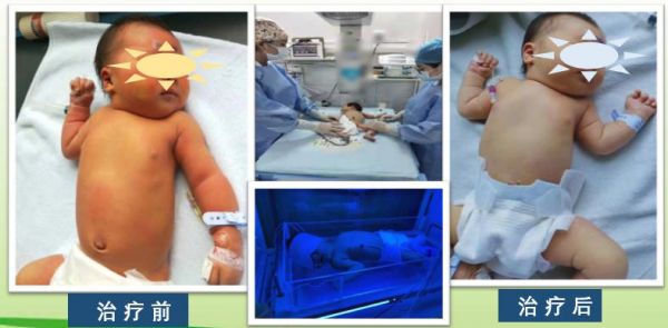健康育儿早知道新生儿黄疸,新生宝宝病理性黄疸如何治疗