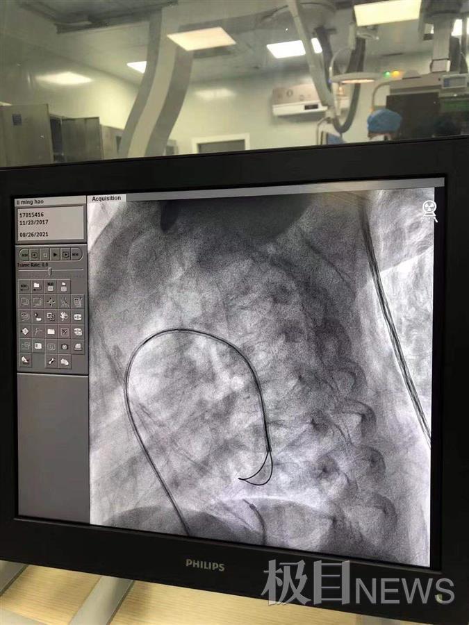 患儿肺炎的案例,小孩重症肺炎是什么原因