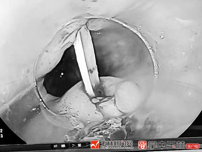 误食鸭骨险成“穿胸利剑”多学科合作化险为夷