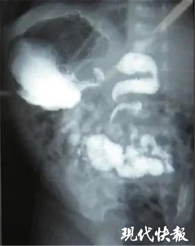 小孩出生第二天嘴里流出血,出生23天嘴里吐泡泡