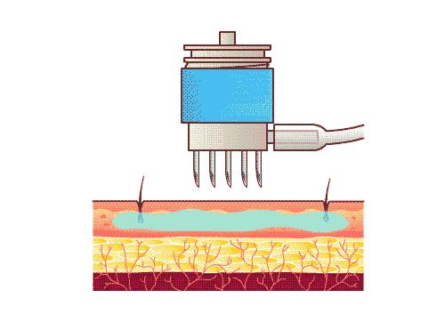 几百的水光仪和几千的区别,几百块钱的水光效果评测