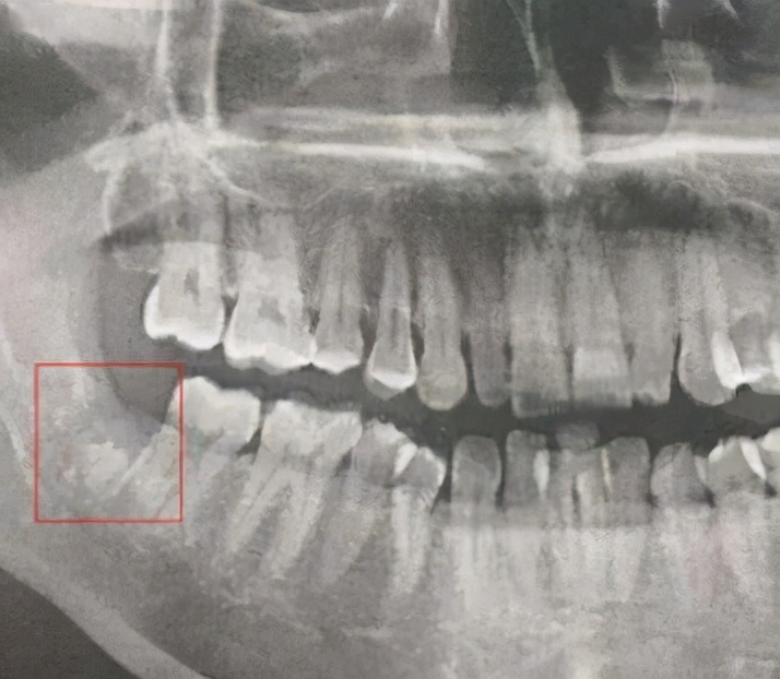 拔牙10天了还会得干槽症吗,拔牙之后干槽症疼痛会持续多久
