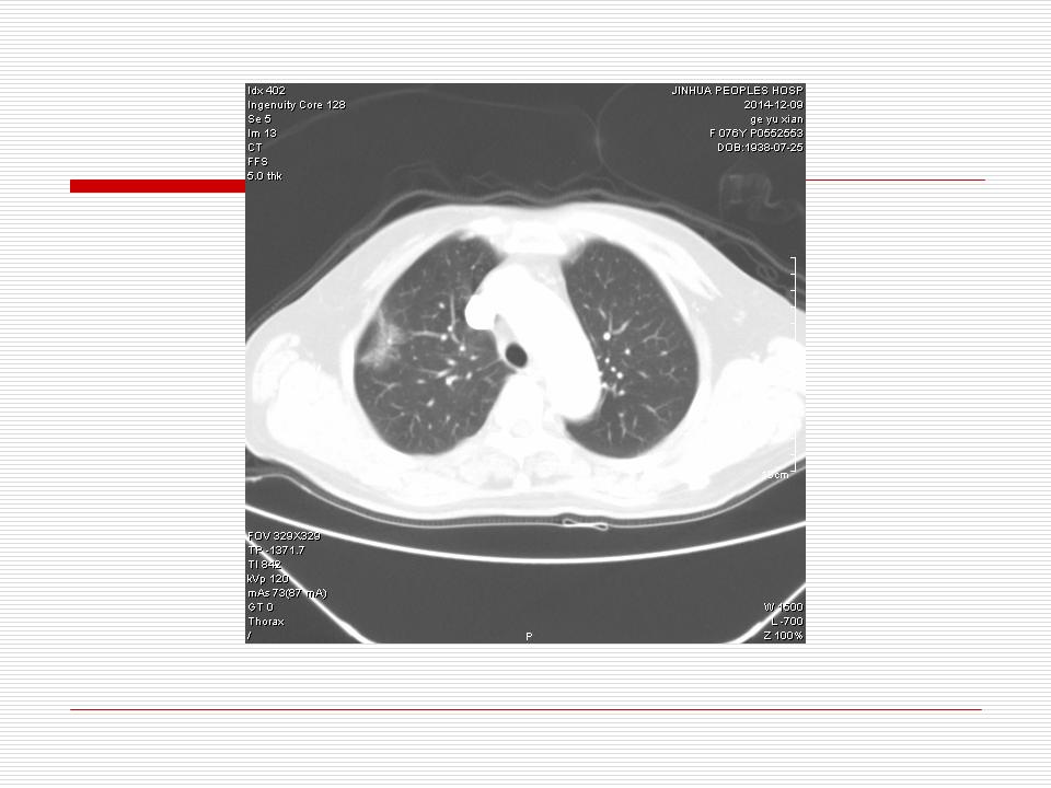 像炎症的肺癌能治好吗,医生说可能是肺癌也可能是炎症