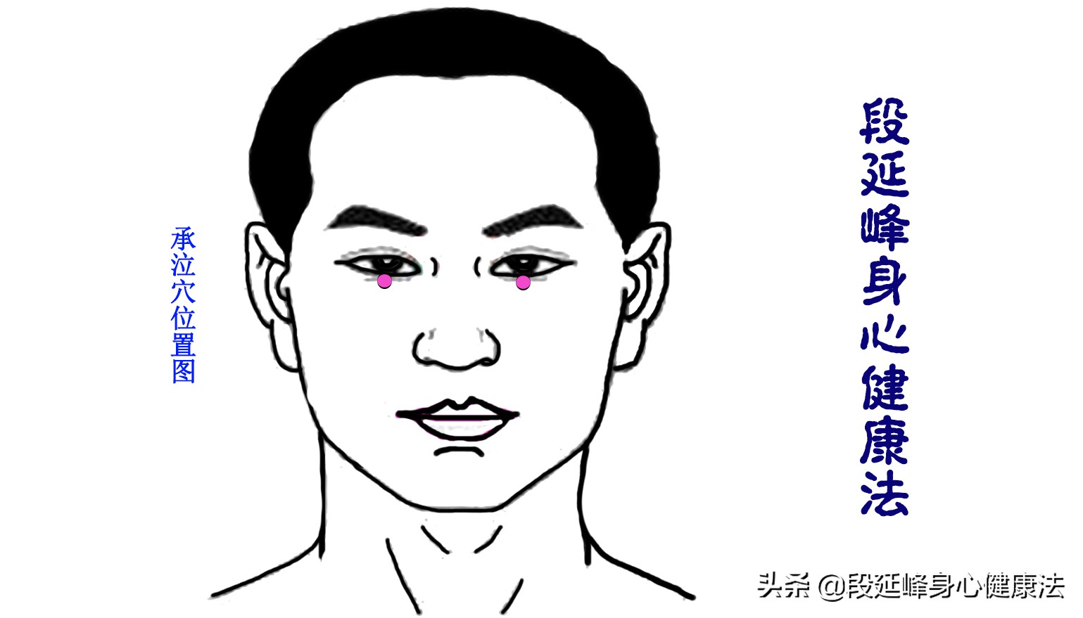 严重黑眼圈可以逆转吗,延峰治疗黑眼圈