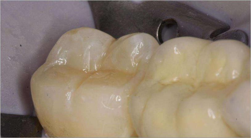 补牙里面灌的水,补牙水很深