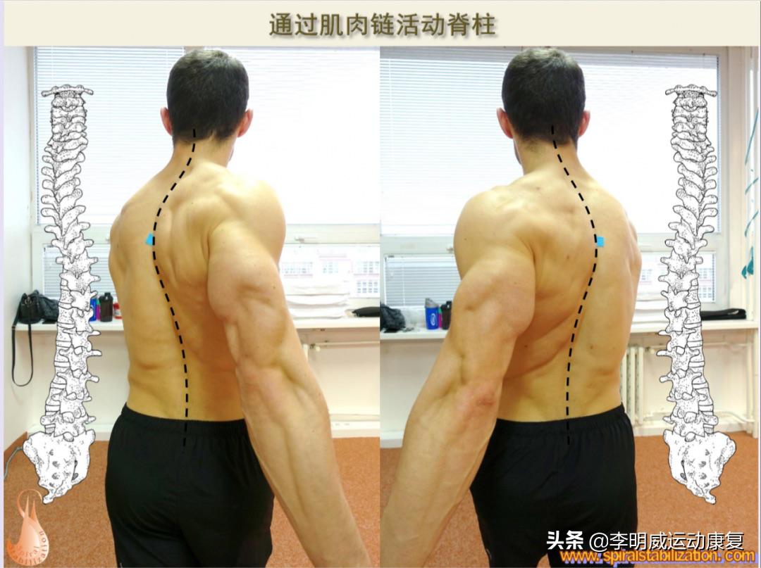 脊柱侧弯自我矫正最好的方法,孩子脊柱侧弯怎么办图片