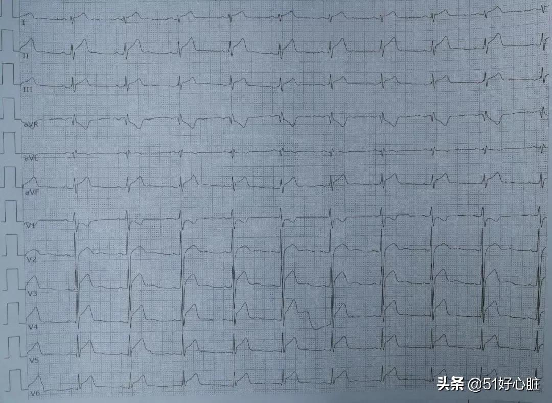 心肌酶高会引起胸闷胸痛吗,突发心肌梗塞是什么原因引起的