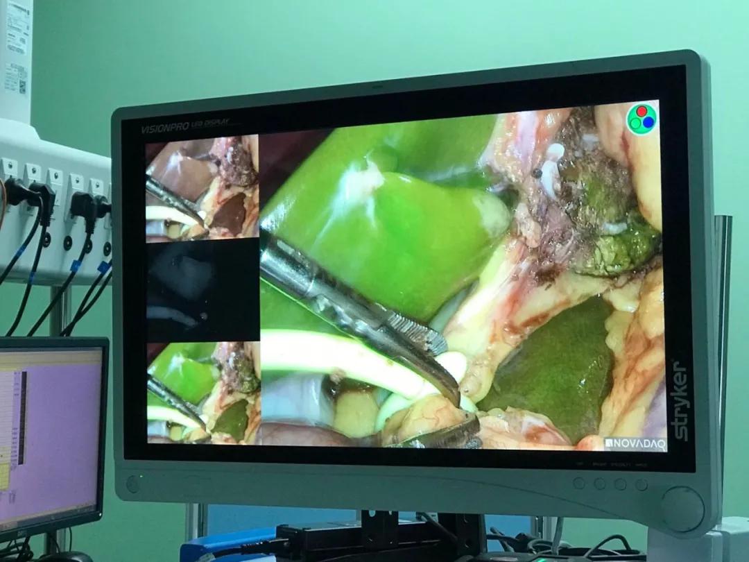 腹腔镜下肝左叶切除术顺利完成,腹腔镜下肝切除适应症