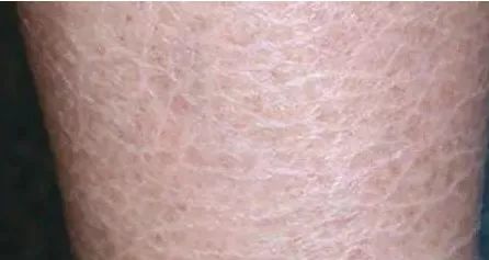 脚后跟干裂小腿皮肤干裂咋回事,脚后跟角质干裂图片