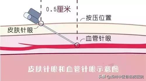 抽血后没按紧有淤血,抽血后按压出现淤血疼怎么办