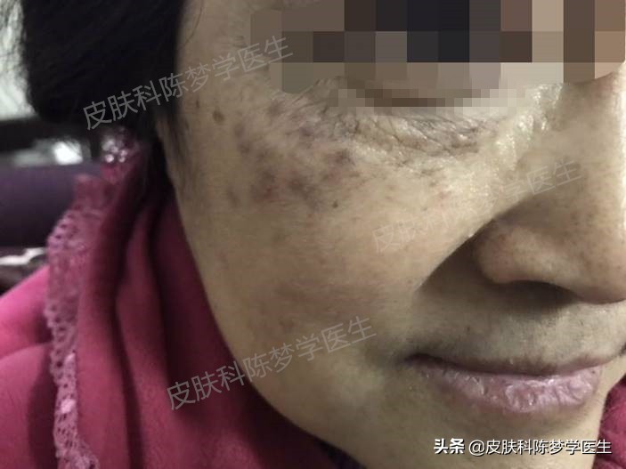 如何治疗脸上褐青色痣样斑,什么是褐青痣斑