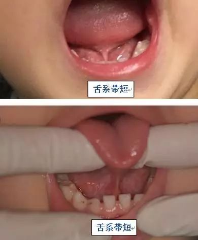 4岁舌系带过短要不要剪,什么是舌系带短图片