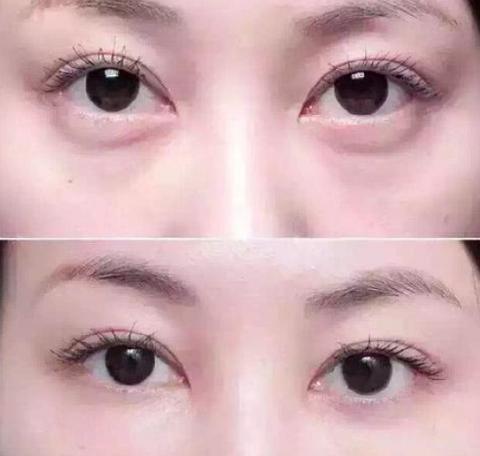 有黑眼圈脸上皱纹很大很显老,眼周黑眼圈显老做什么医美