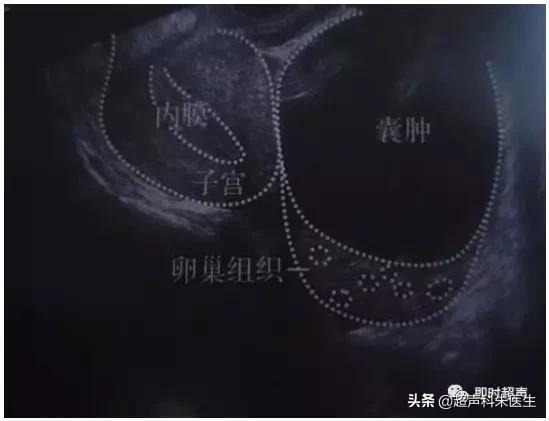 妇科超声的标准超声图,妇科超声图解