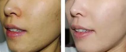 激光美白建议做吗,对激光还有哪些了解