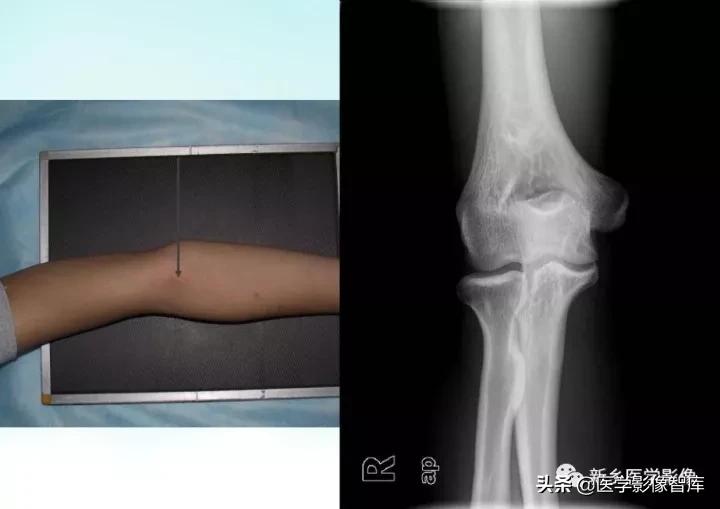 肘关节x线测量,肘关节骨骺示意图