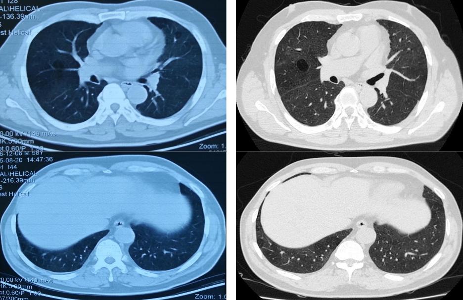 养鸽子造成皮肤真菌感染,养鸽子会得肺炎吗