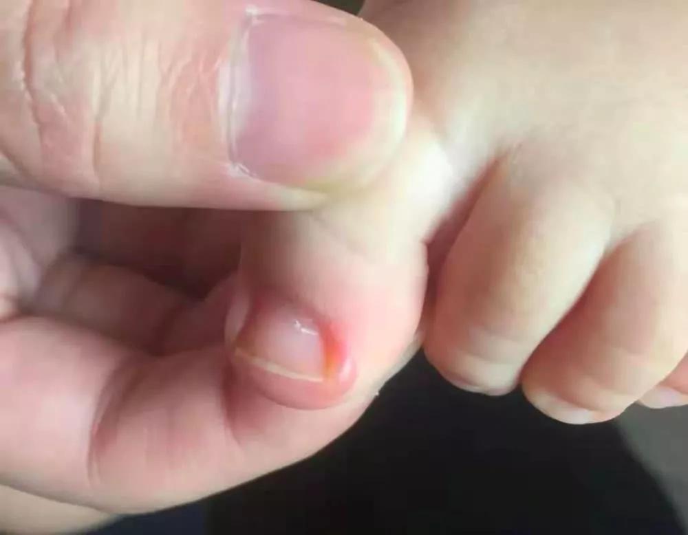 宝宝脚趾甲往肉里长怎么剪,宝宝脚趾甲长到肉里怎么办